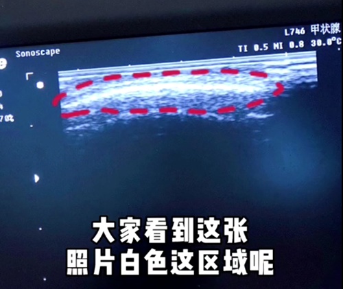 熱瑪吉和超聲刀應(yīng)該怎么選