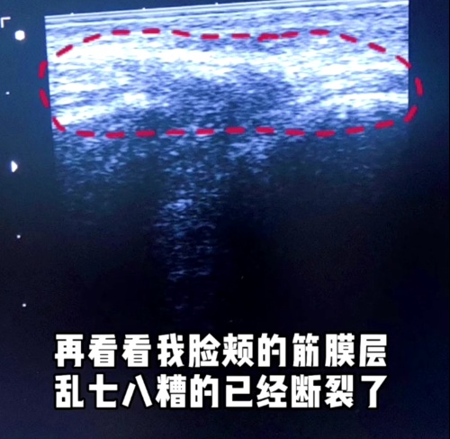 熱瑪吉和超聲刀應(yīng)該怎么選